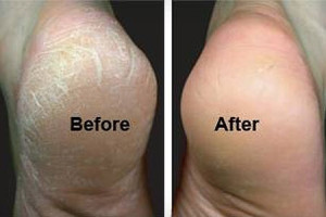 foot callus removal, callus treatment, hard skin on feet