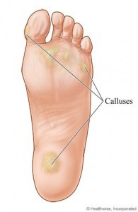 Calluses can happen in all parts of your feet