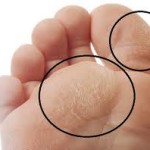 Is It Possible to Have Permanent Callus Removal?