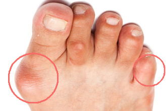 What are the Side Effects of Corns and Callus?